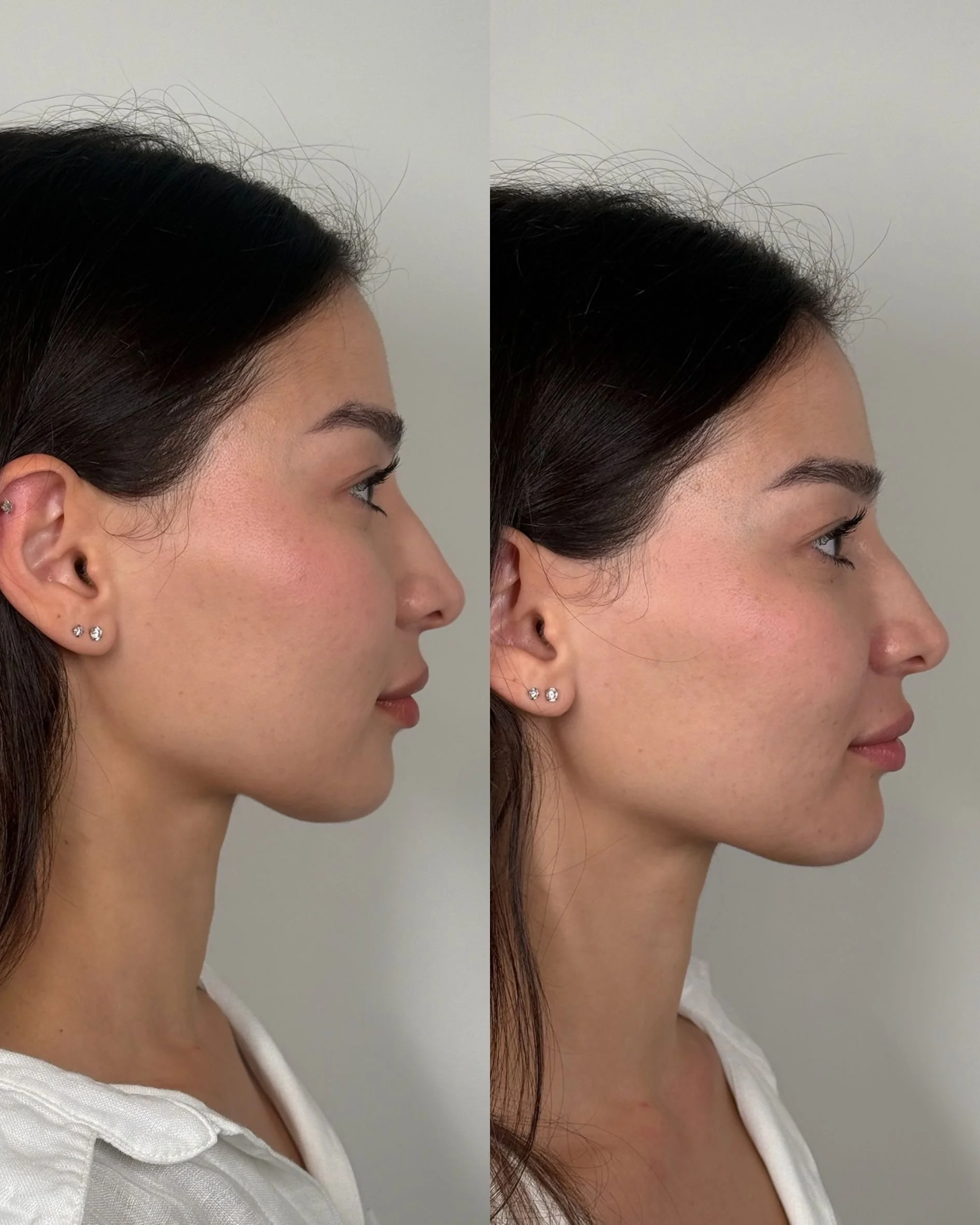 CHIN FILLER.jpg