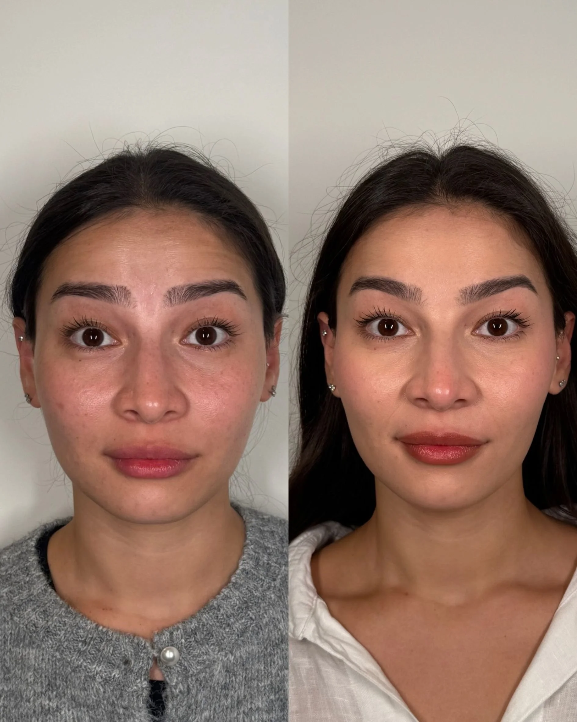 BOTOX (3).jpg