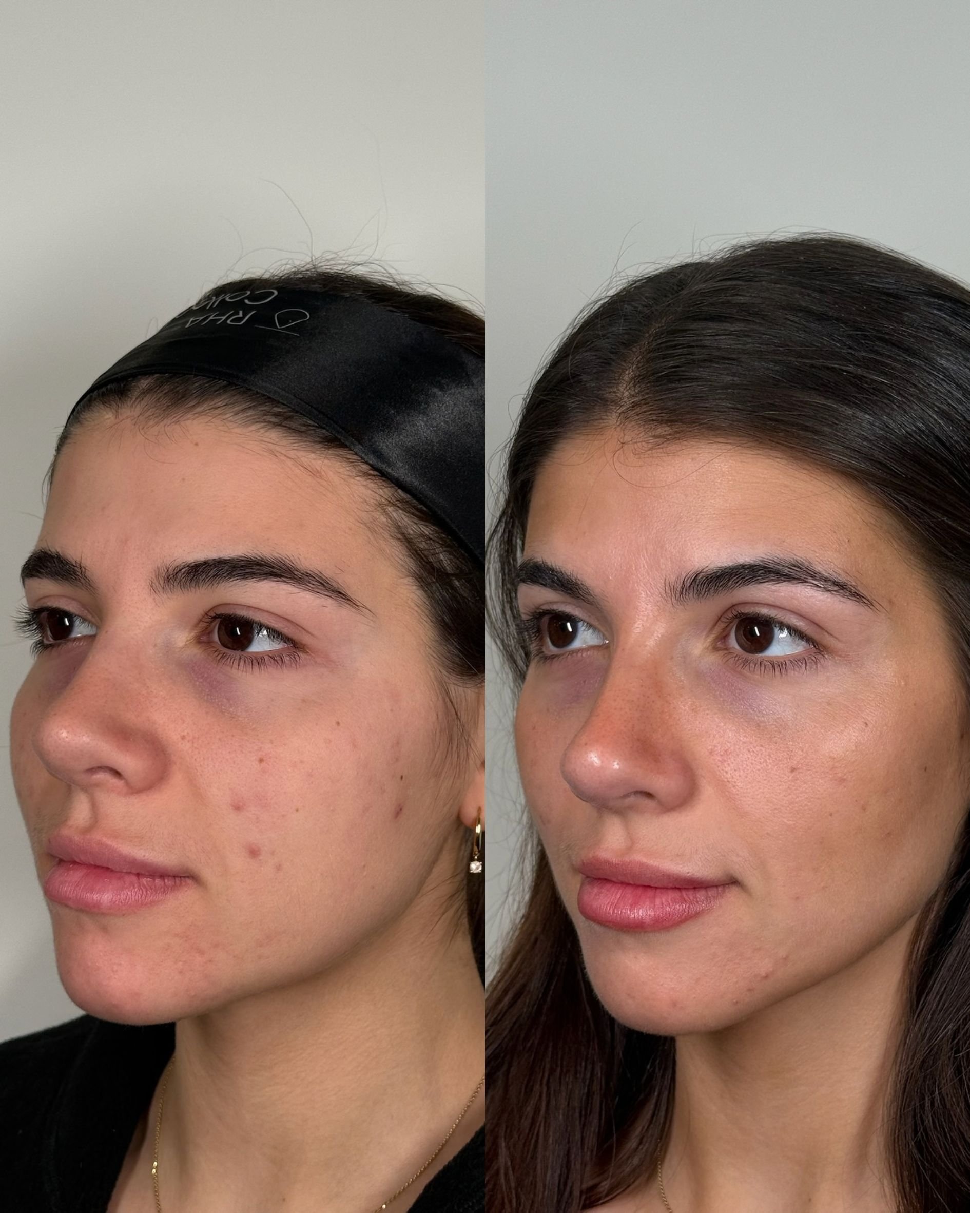 Microneedling