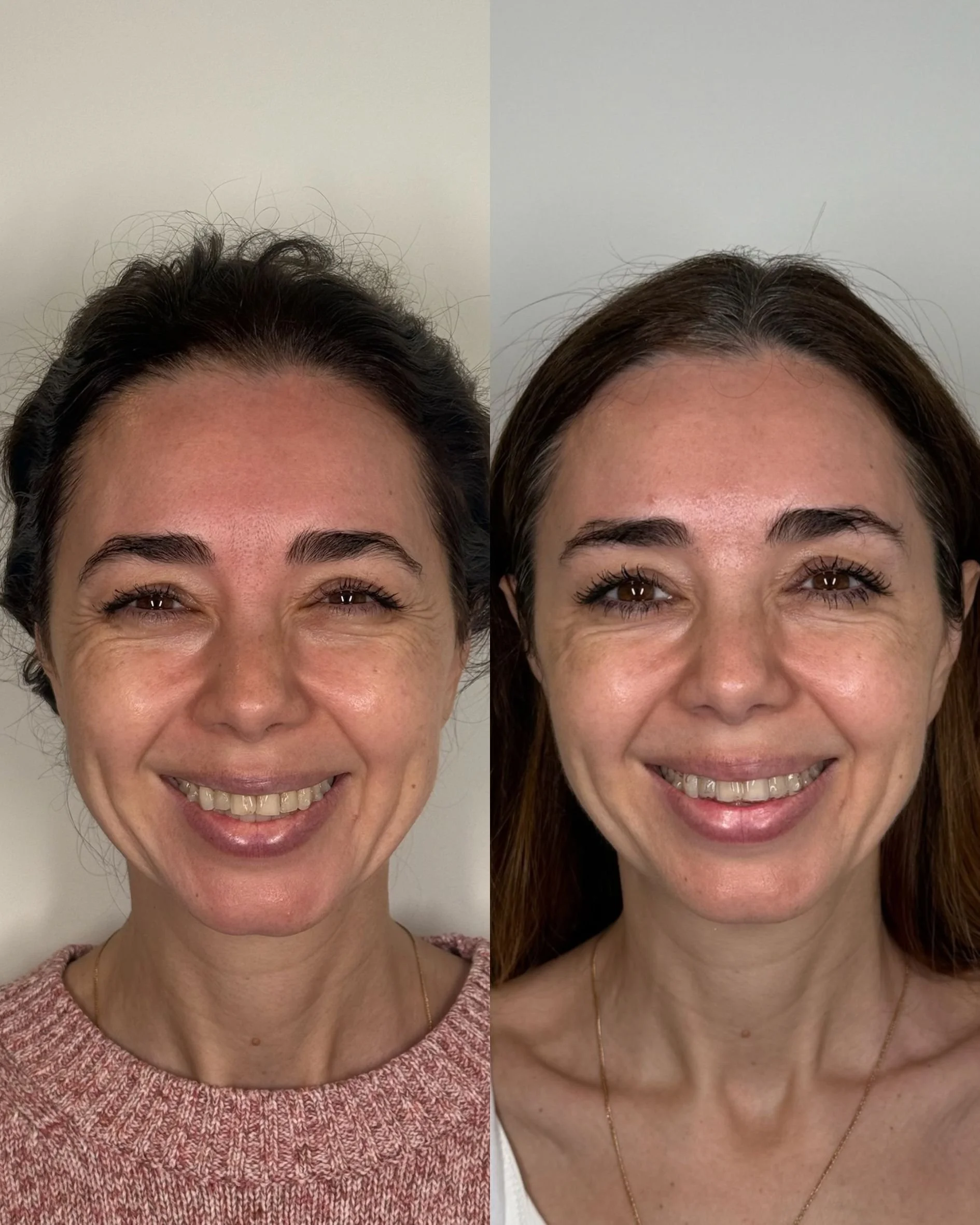 BOTOX (2).jpg