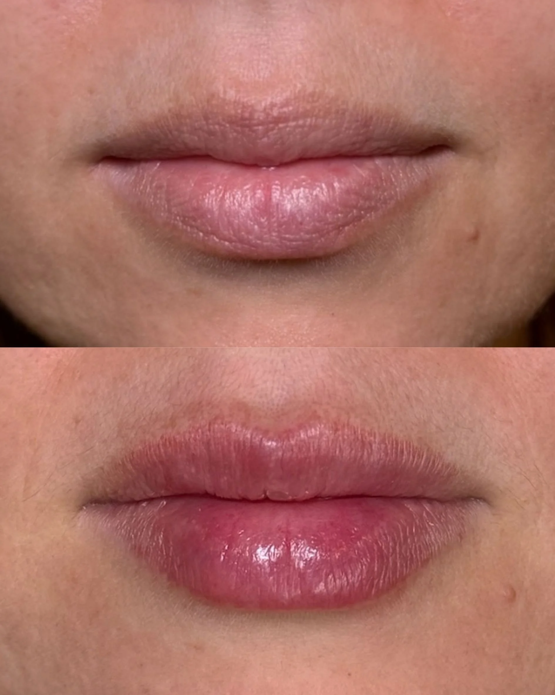 LIP FILLER (2).jpg