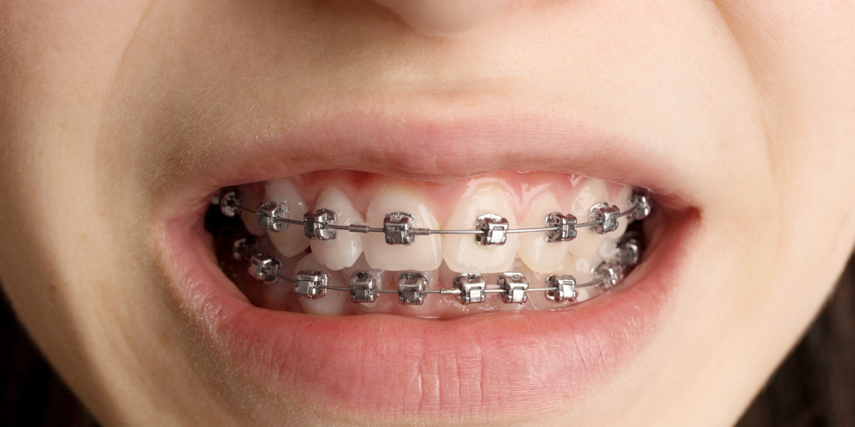 Surgical-Assisted Orthodontics