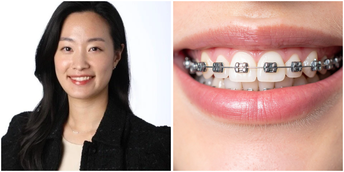 How Long Do Braces Take? Understanding Your Treatment Timeline