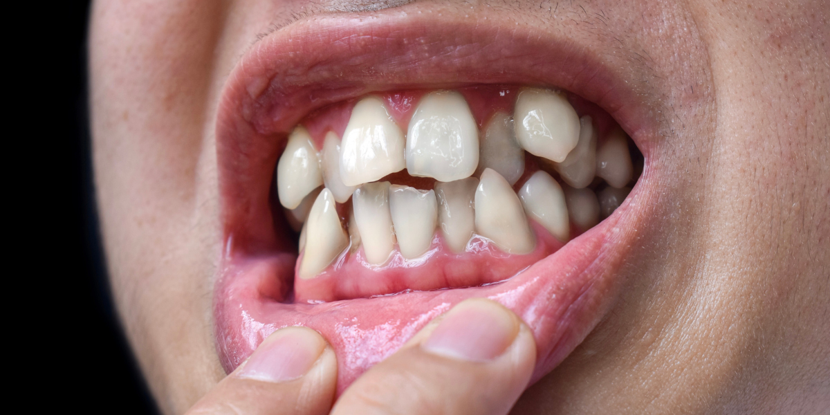 Treat Misalignment Now