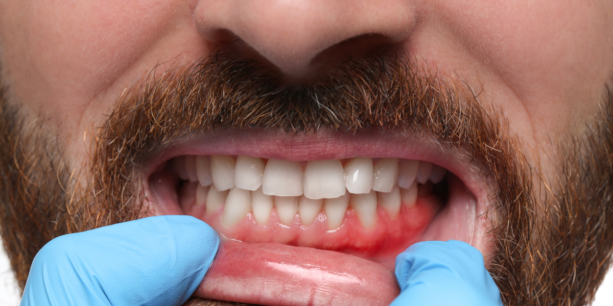 Overbite: When the Upper Teeth Overlap Too Much