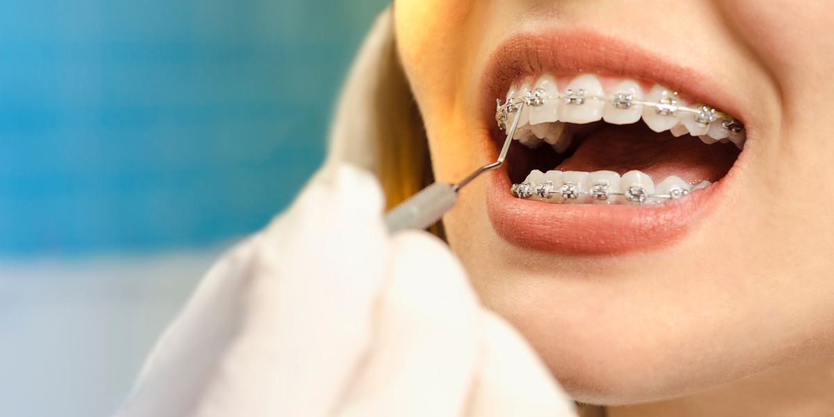 Why Choose Paramus Orthodontics for Your Braces