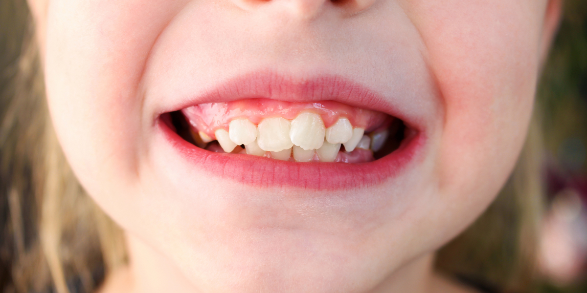 Overbite Treatment in Paramus, NJ | Paramus Orthodontics — Paramus ...