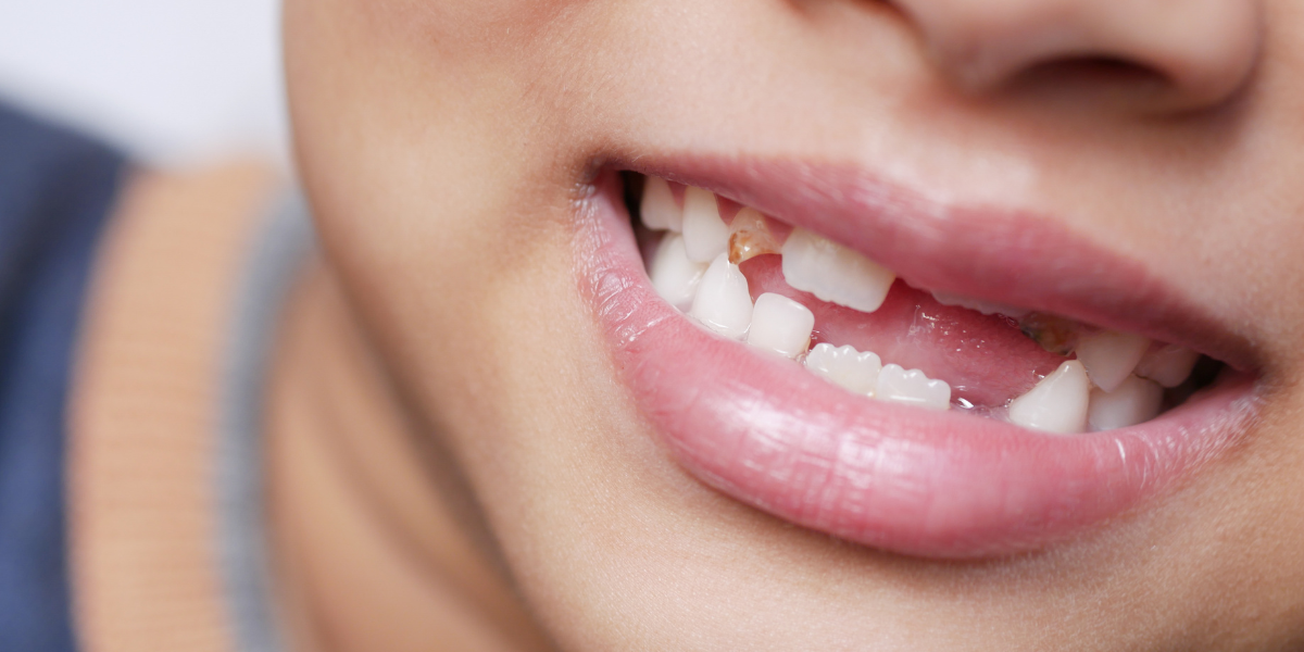 Signs That Early Tooth Loss May Be a Problem