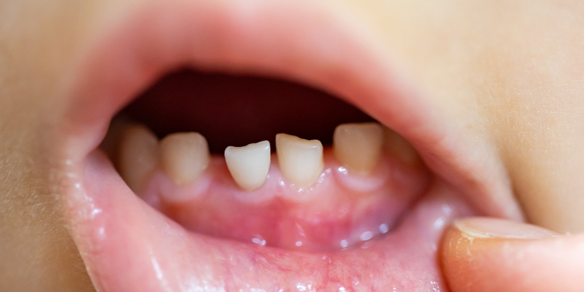 Risks of Losing Baby Teeth Too Soon