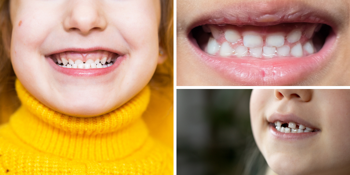 Underbite vs Overbite vs Crossbite:  What’s the Difference, and Why It Matters for Function