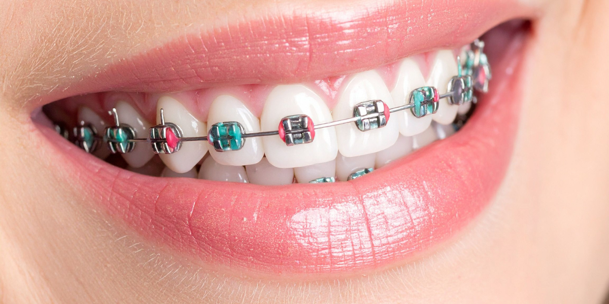 What Factors Affect How Long Braces Take