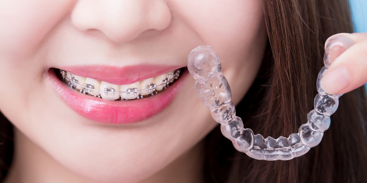 Braces vs. Clear Aligners_ Which Is Faster