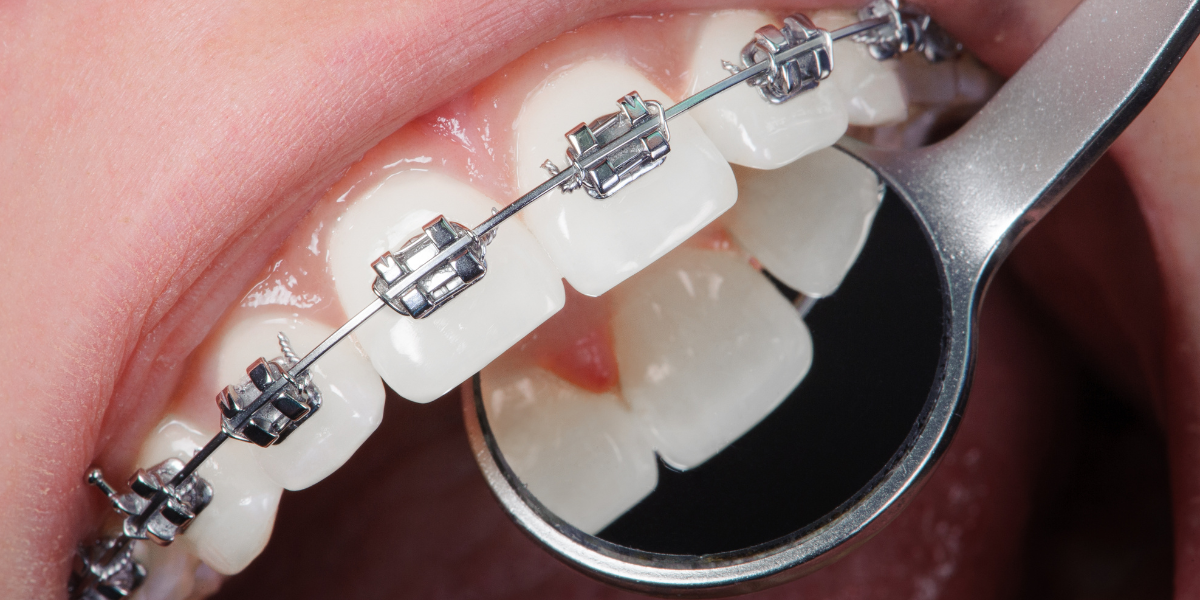 Why Do Braces Affect Speech At First?
