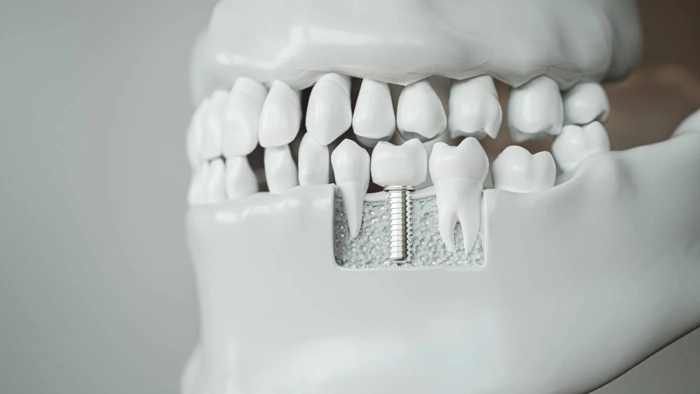 Kiefermodell mit Zahnimplantat auf der unteren Zahnreihe, sichtbar mit Schraube und künstlichem Zahn.