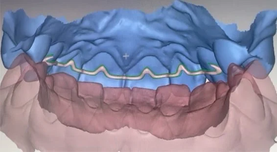 Digitales 3D-Modell eines unteren Kieferkiefers mit kieferorthopädischem Draht
