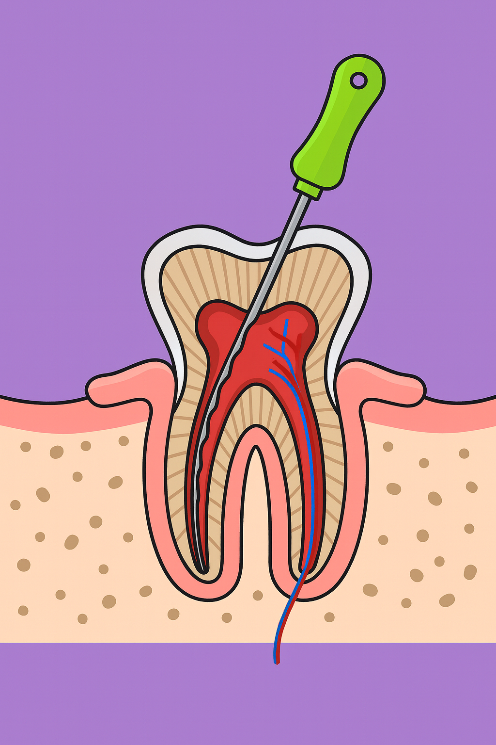 Illustration eines Zahnarztes, der eine Wurzelbehandlung an einem Zahn durchführt.