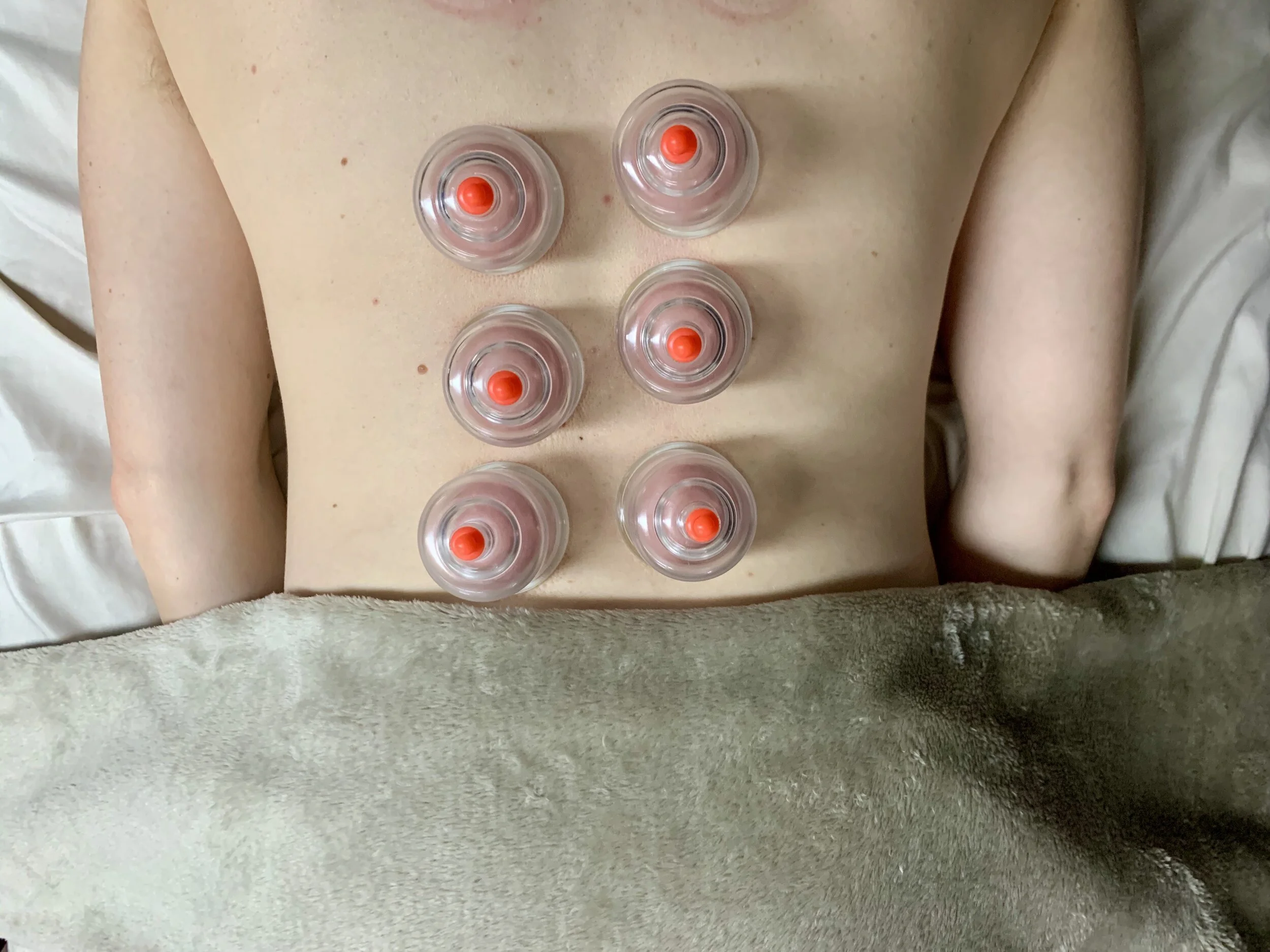 Cupping Therapy 101: For Olympians and You!