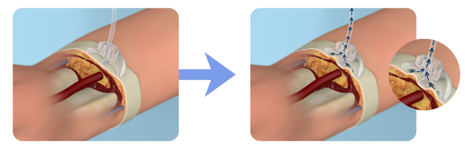 Transradial Technologies, Inc.