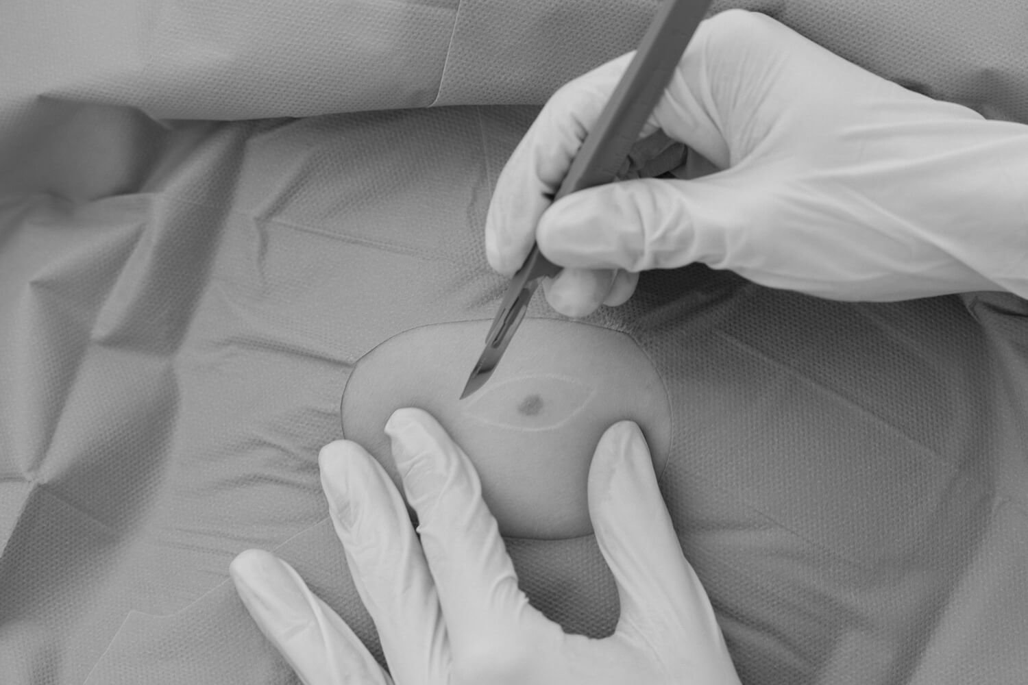 Operative ambulante Eingriffe bei Dr. Tamara Arnoldner - Dermatologin in Wien