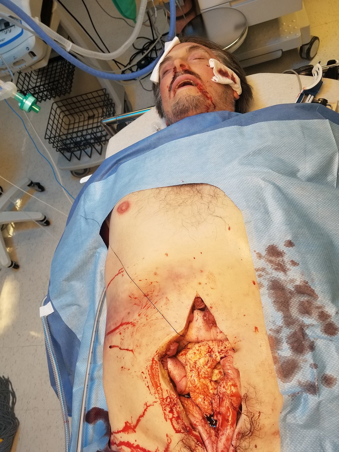 Patient sur une table d'opération à l'hôpital avec une blessure abdominale ouverte et des équipements médicaux autour.