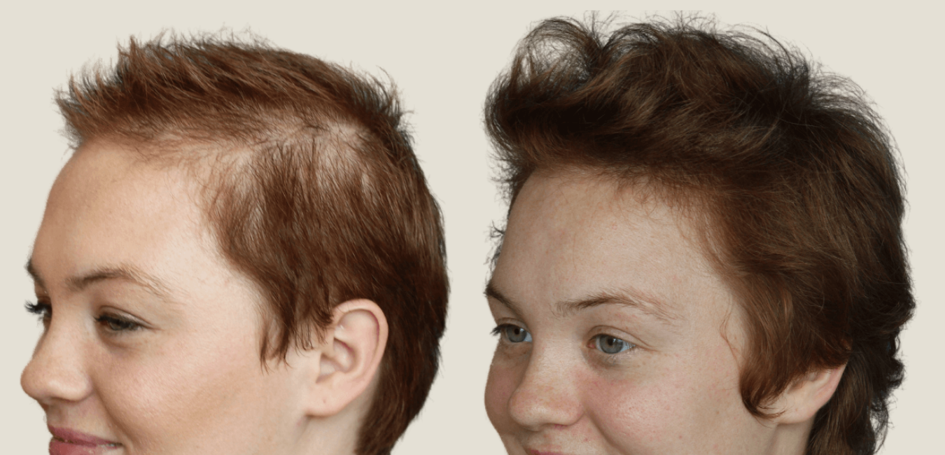 before and after telogen effluvium glp1