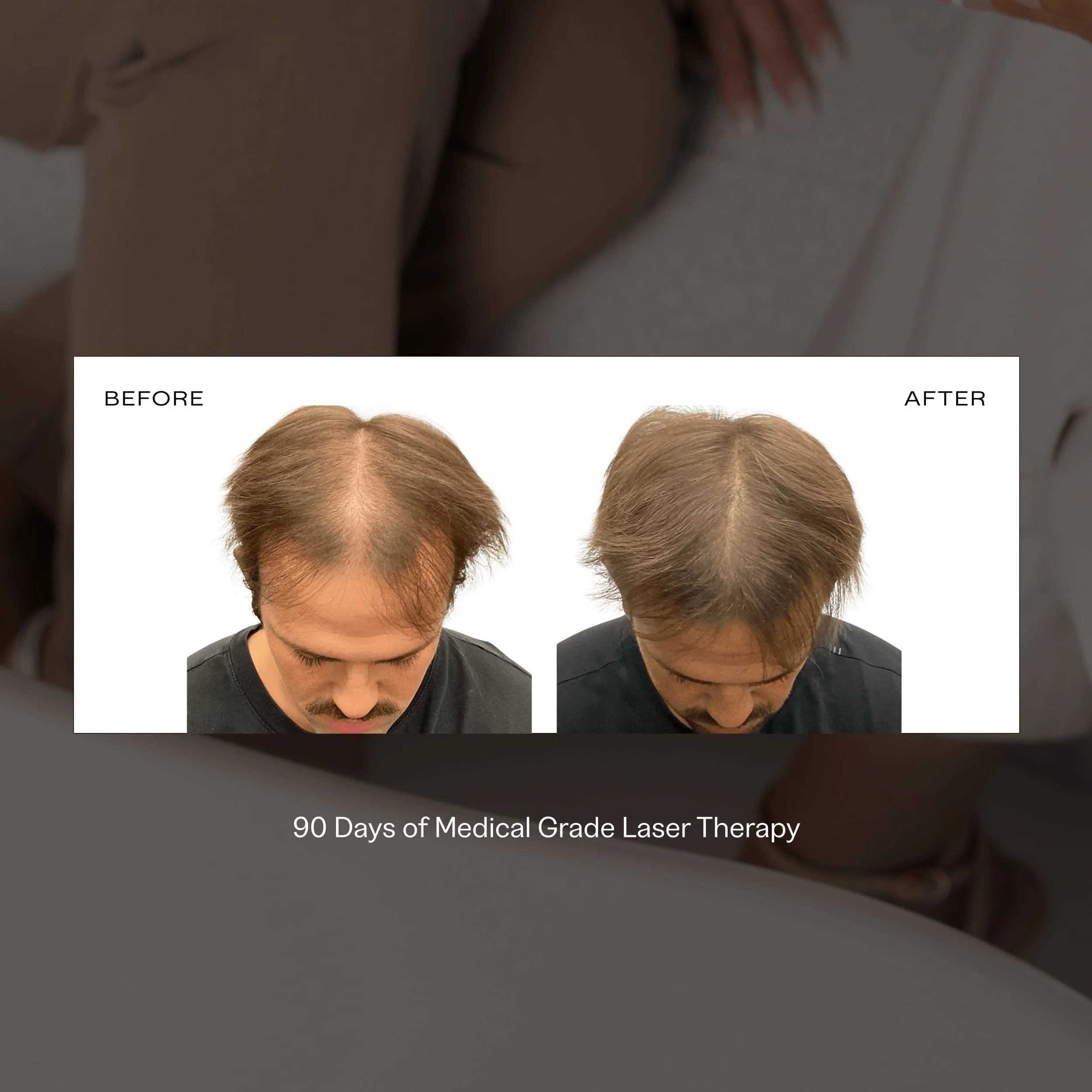 laser hair loss before and after.jpg
