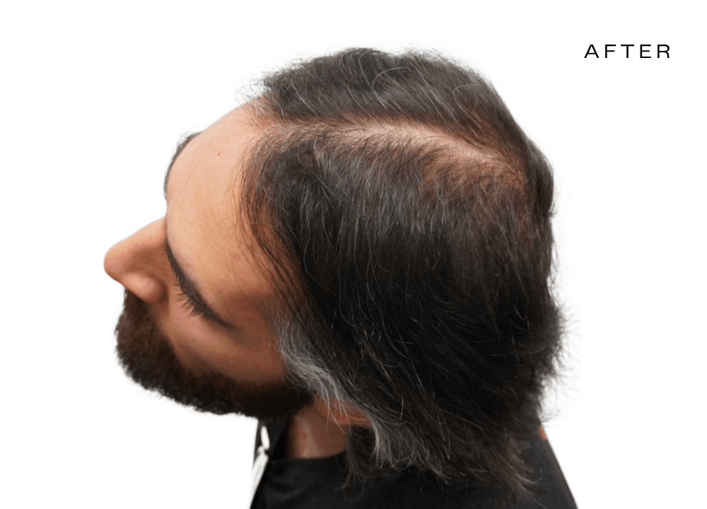 male before and after hair loss clinic scottsdale