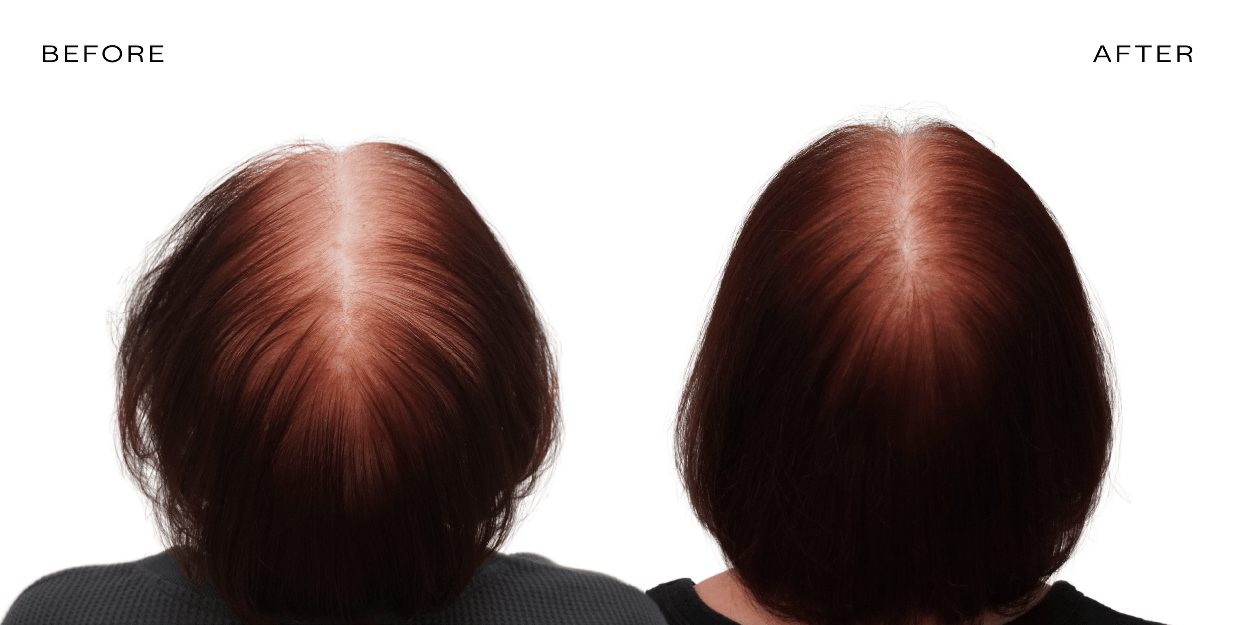 before and after secretomes hair growth