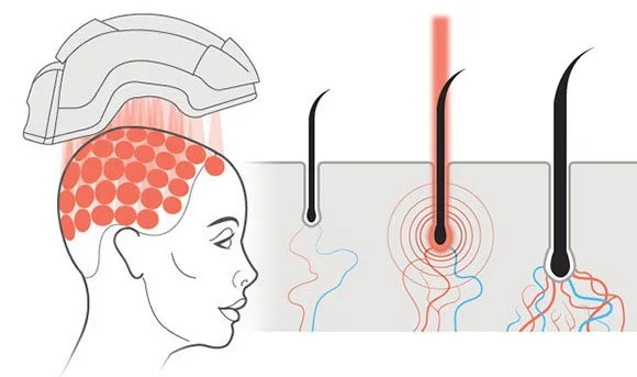 understanding medical grade LLLT for hair growth