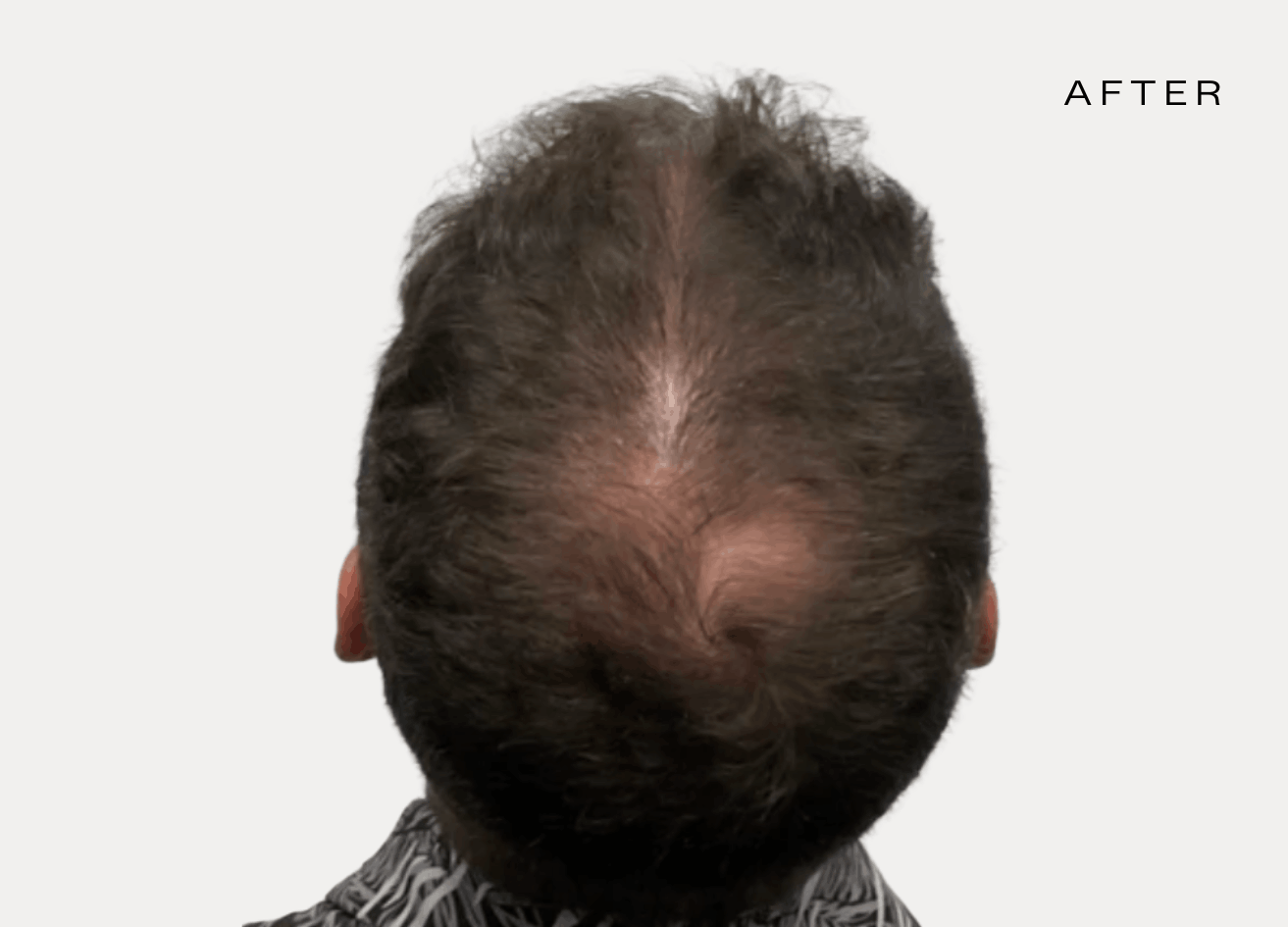 male hair restoration treatments