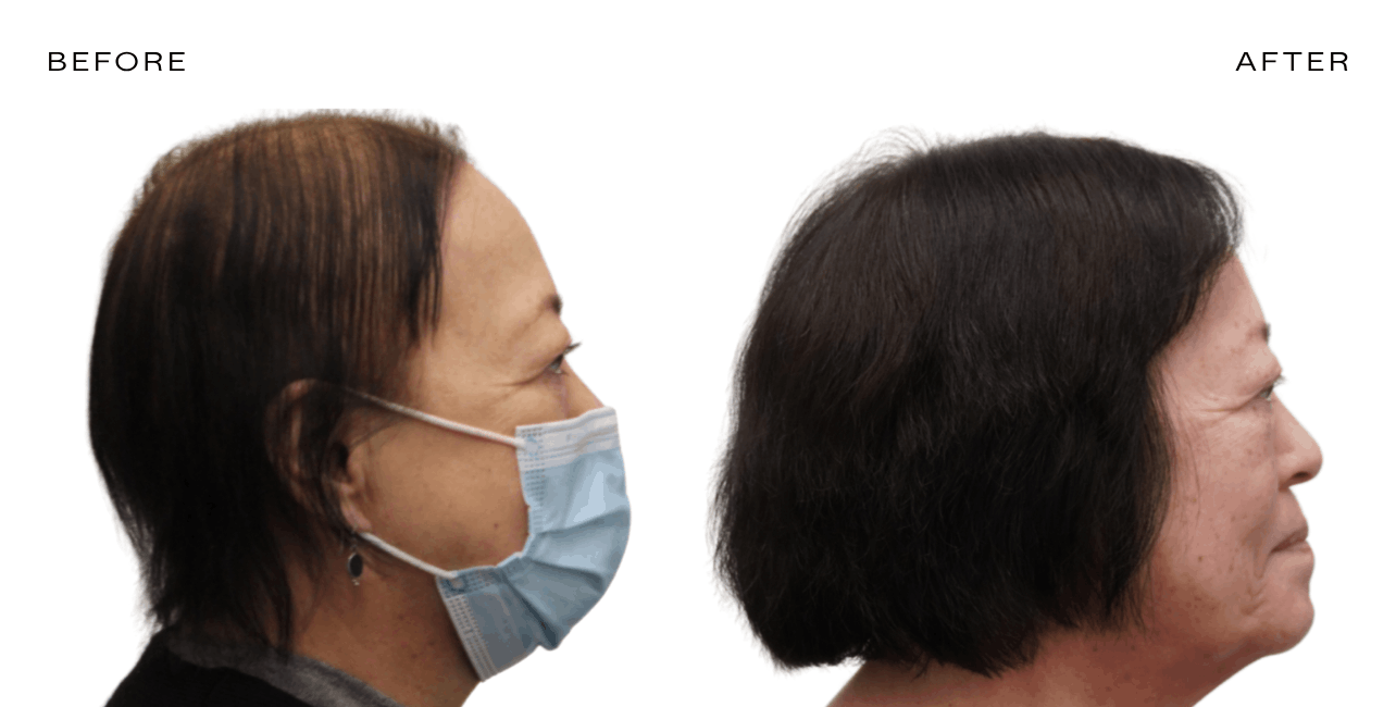 exosome therapy for hair loss scottsdale phoenix nhlma