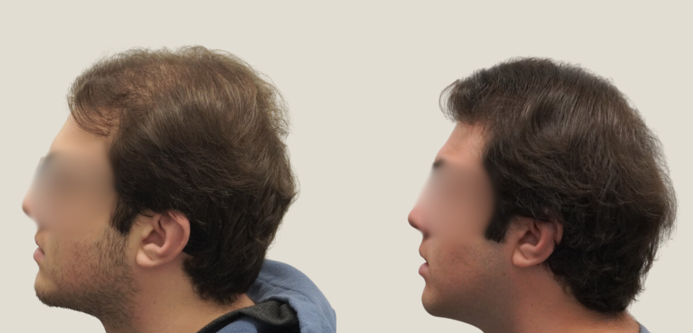 image of hair loss because of glp1