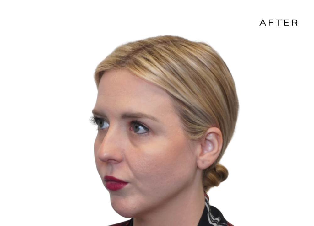 dermal filler face before and after.png