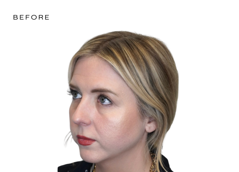 dermal filler face.png