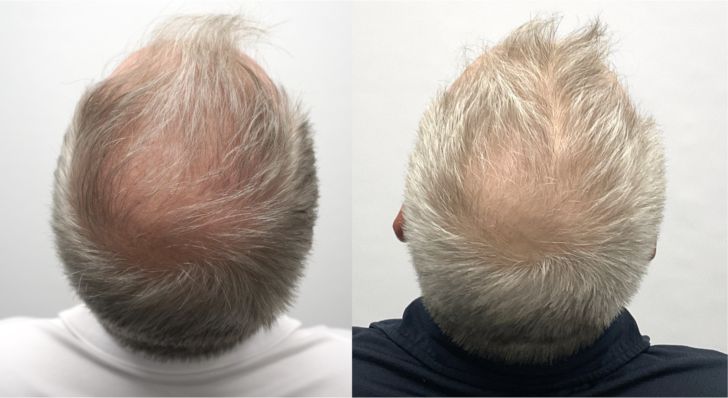 male genetic hair loss expert scottsdale.png