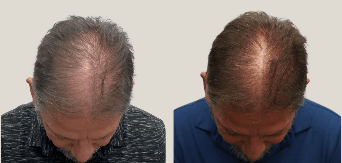 male genetic hair loss.png