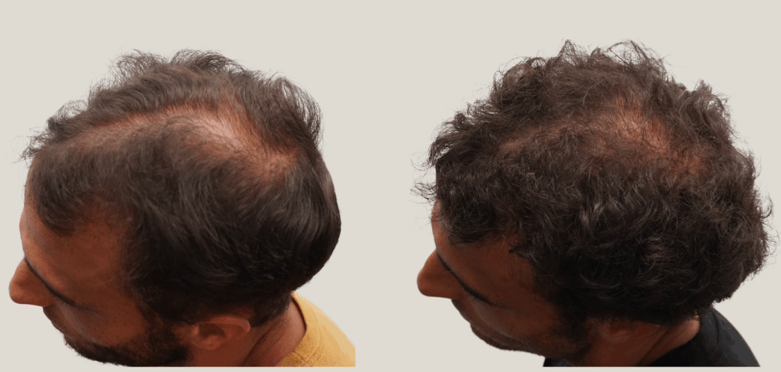 medical grade laser hair therapy.png
