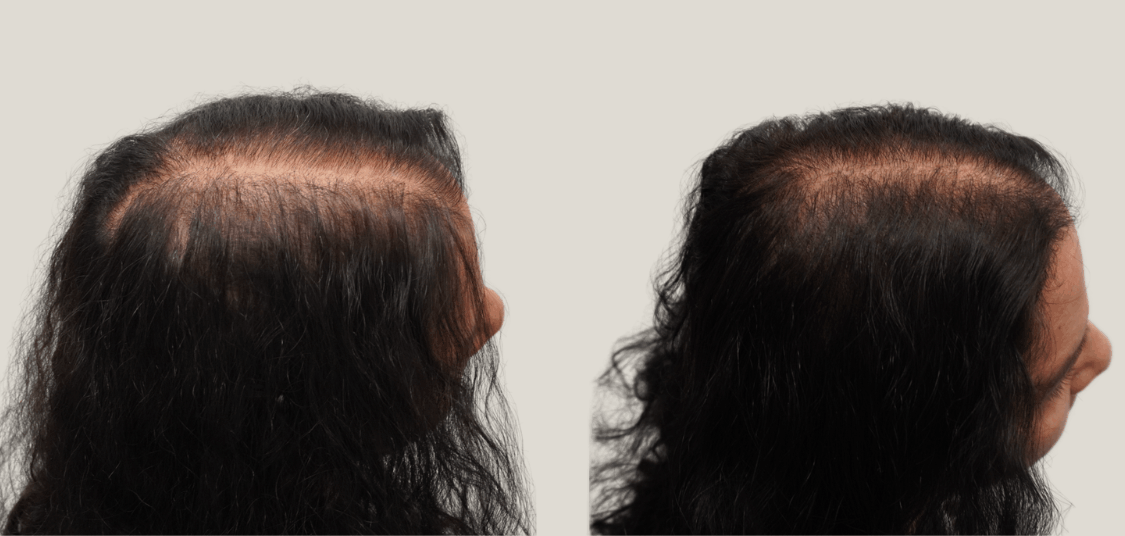 exosome hair thearpy.png