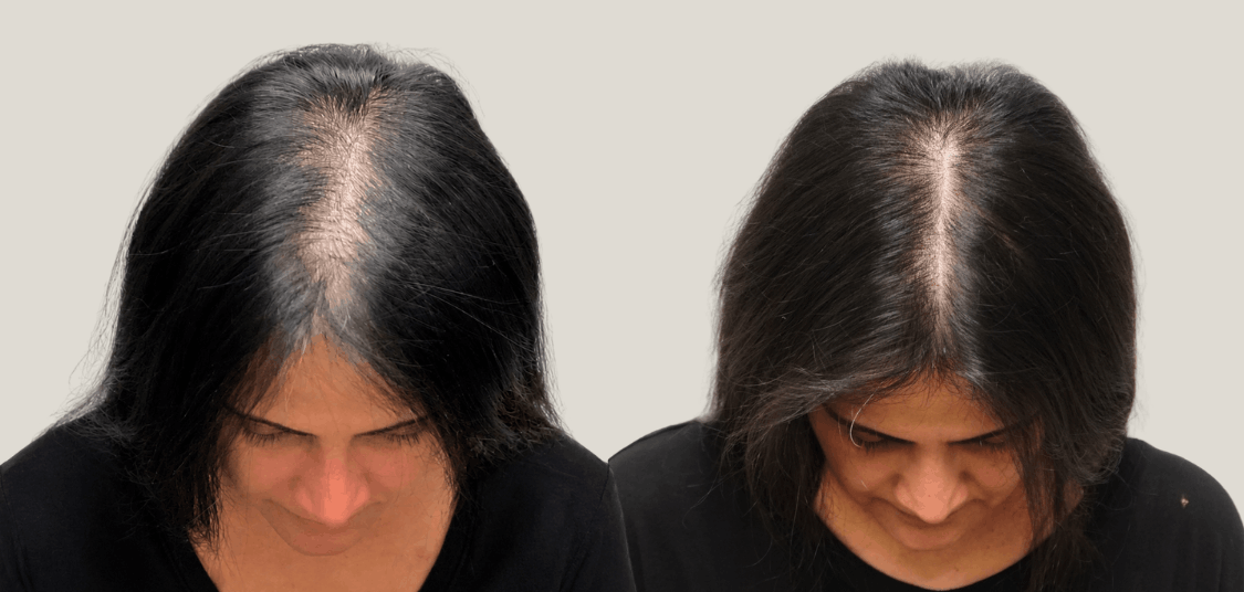 female genetic hair loss.png