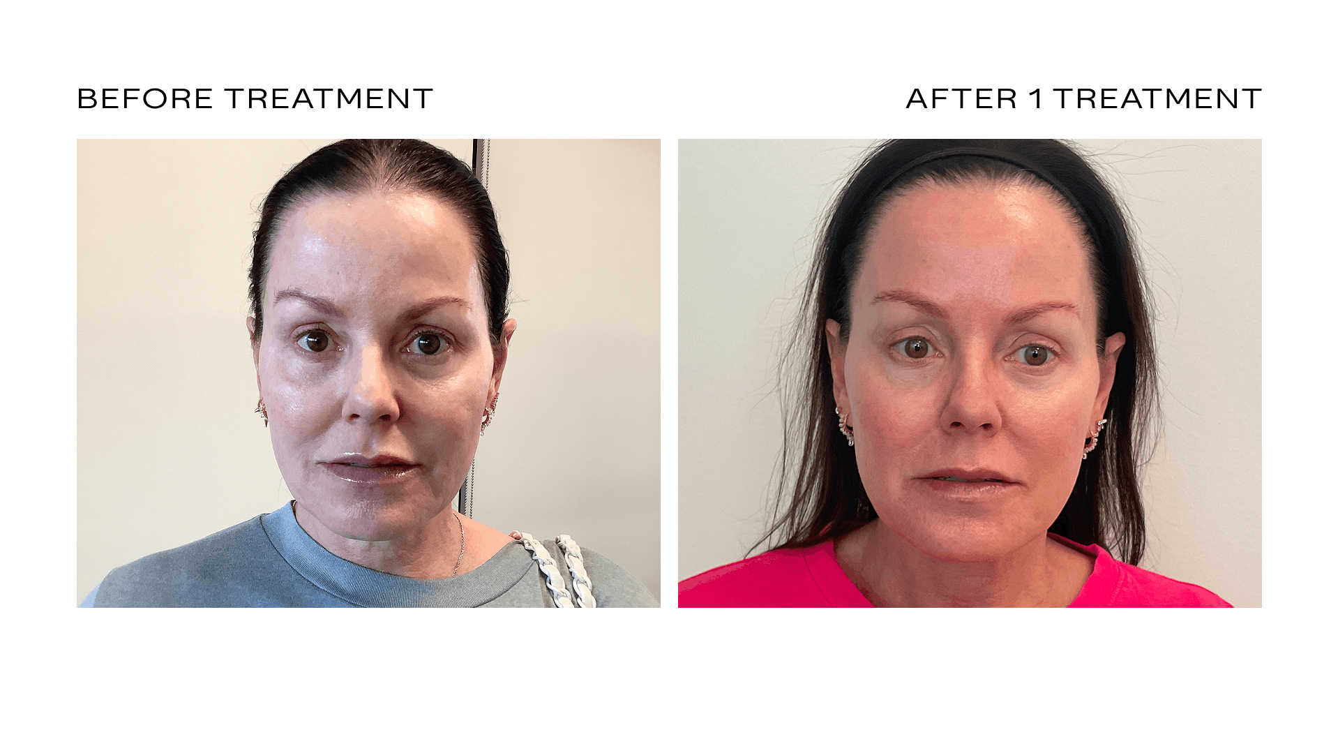 fractional skin resurfacing scottsdale.png