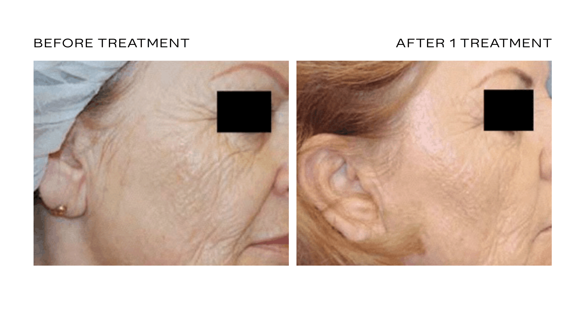 laser skin resurfacing treatment scottsdale.png