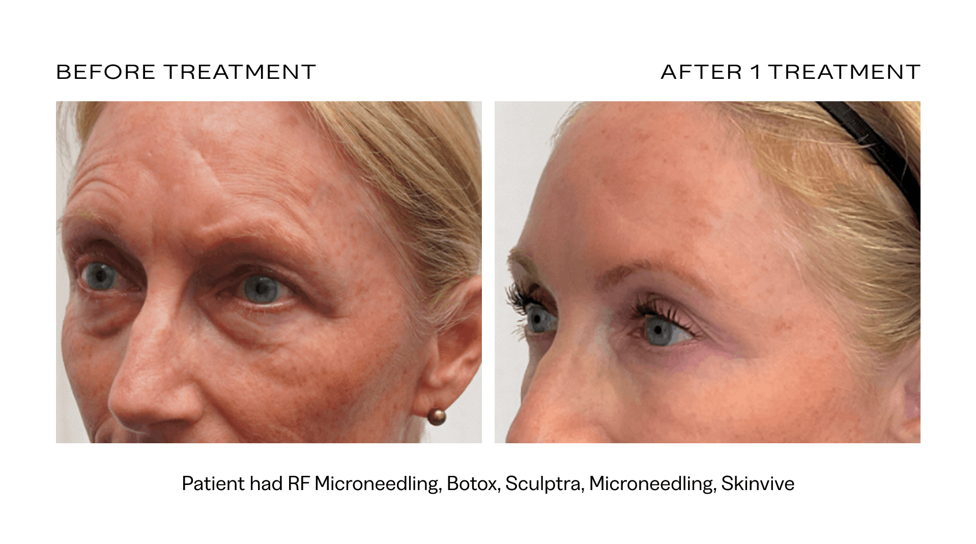 rf microneedling treatment scottsdale.png
