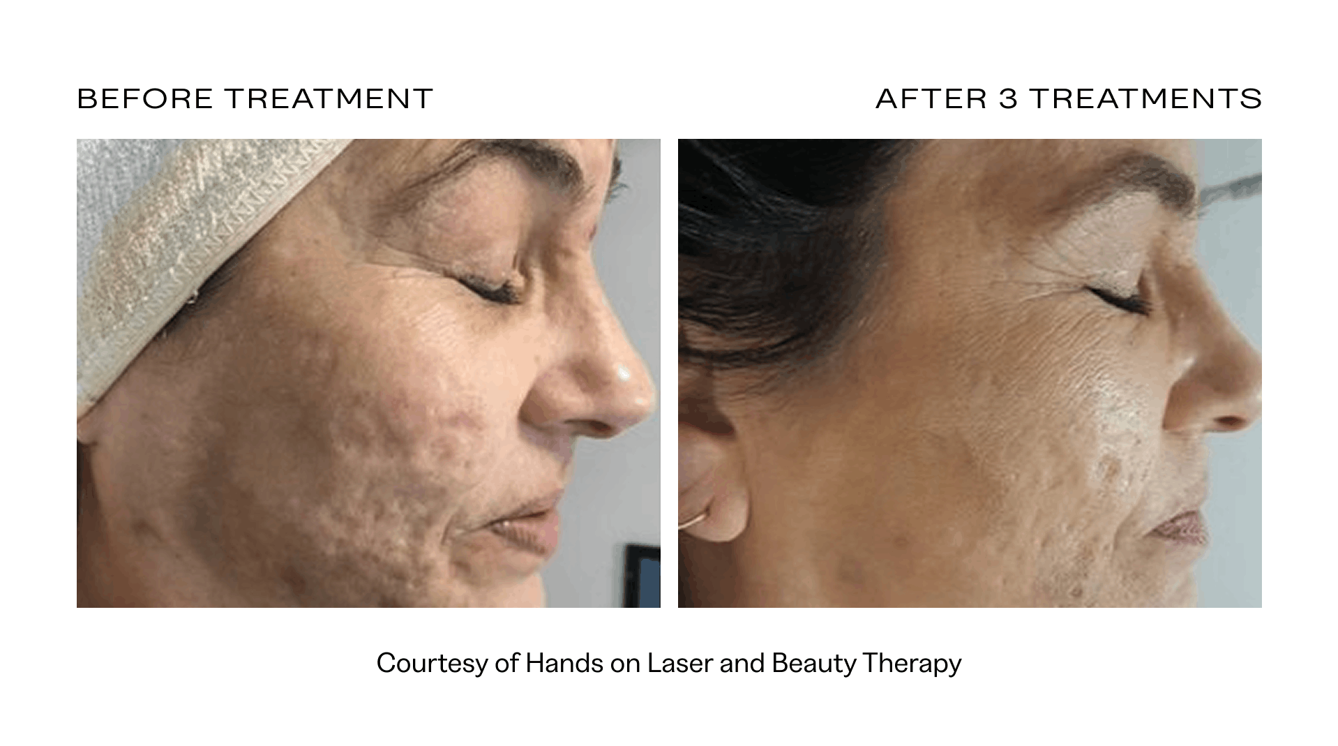 rf microneedling before and after.png