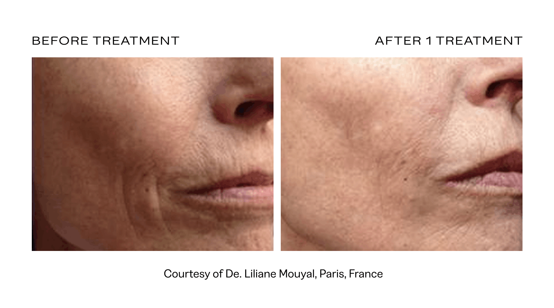 rf microneedling phoenix.png