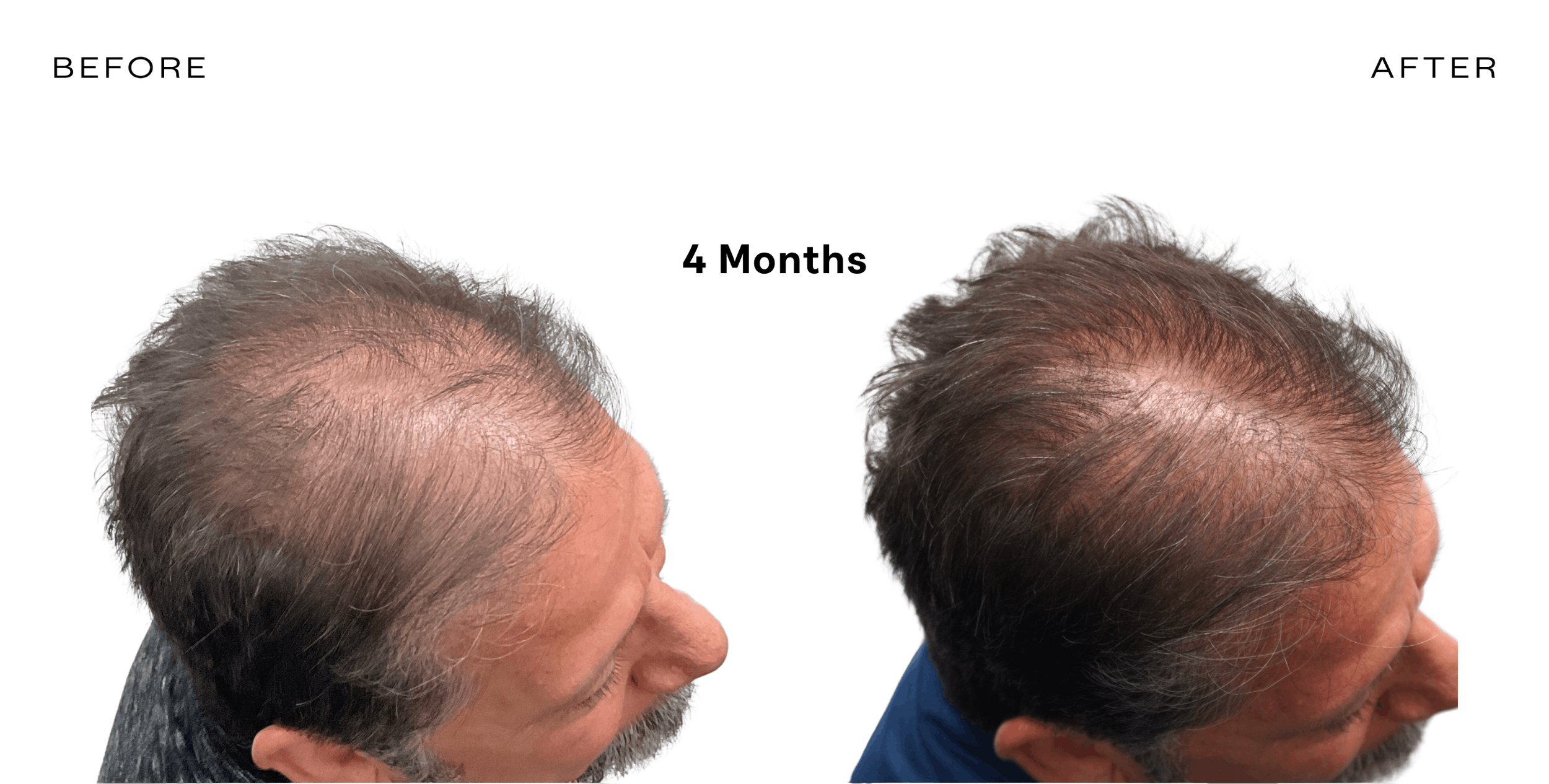 before and after hair loss arizona 2.png
