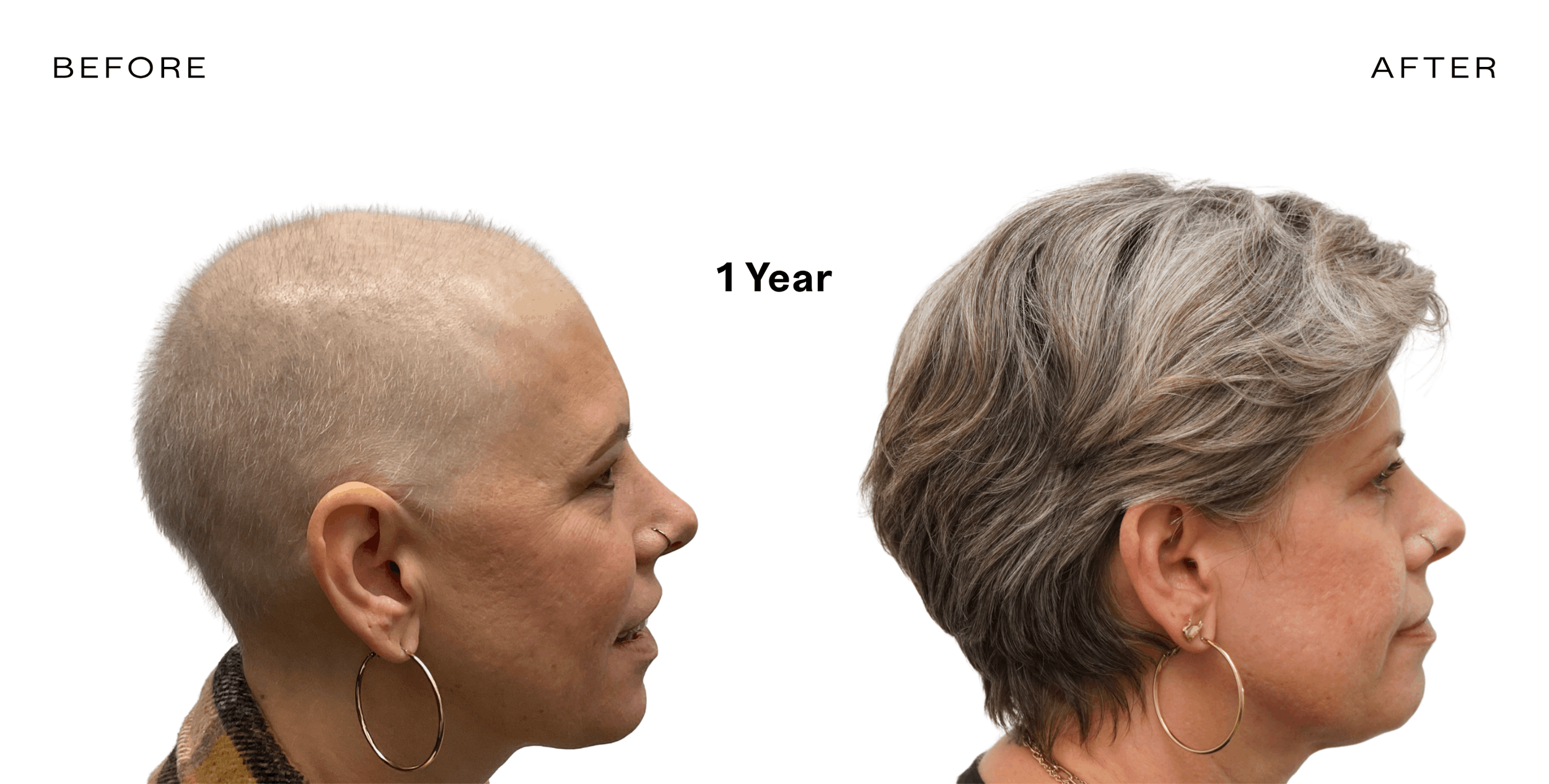 before and after hair loss arizona3.png