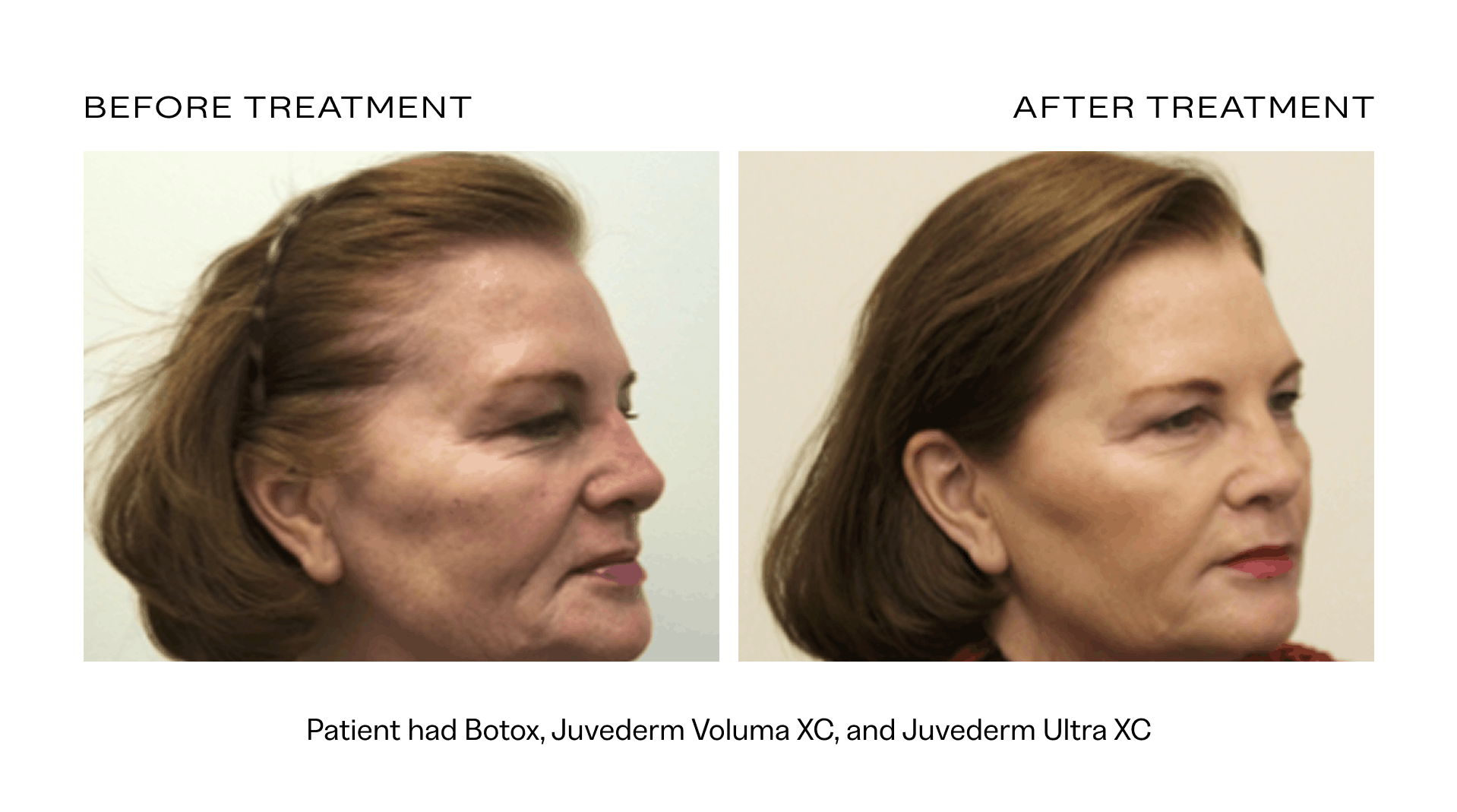 before and after juvederm scottsdale