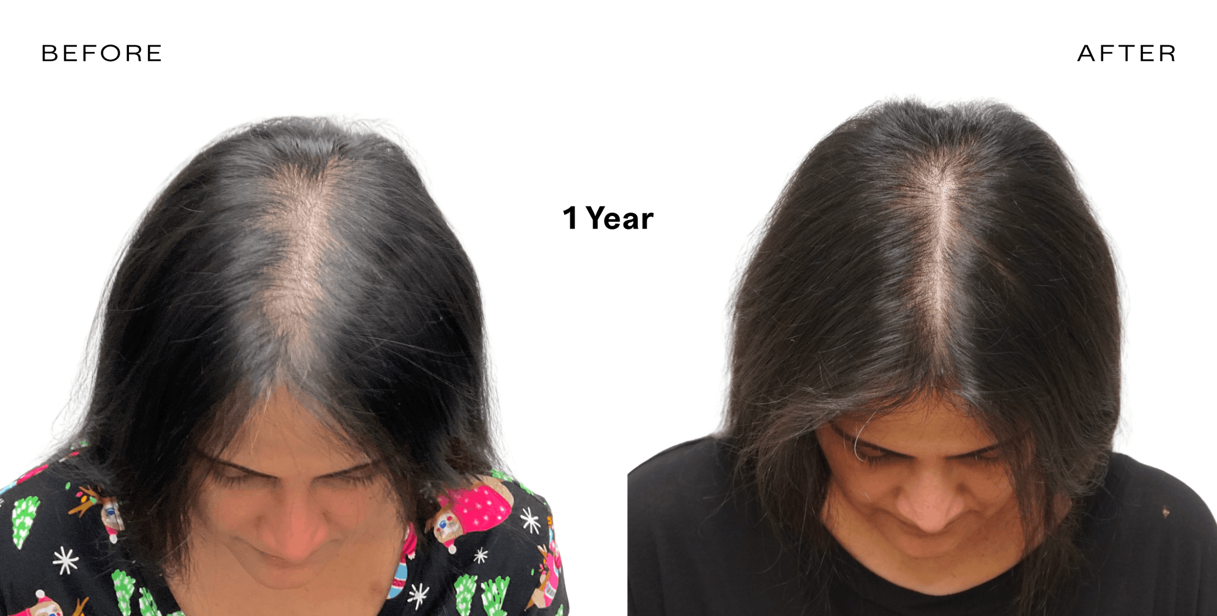 exosome therapy for hair loss