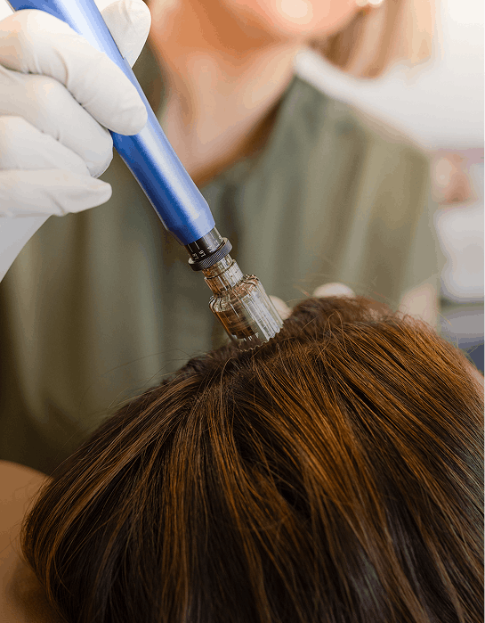 scalp microneedling for hair loss