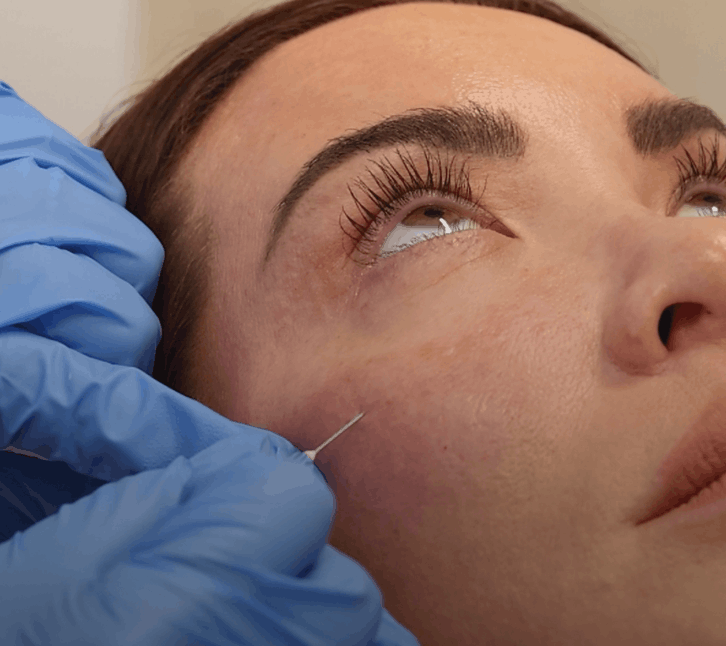 prp-therapy-face Scottsdale